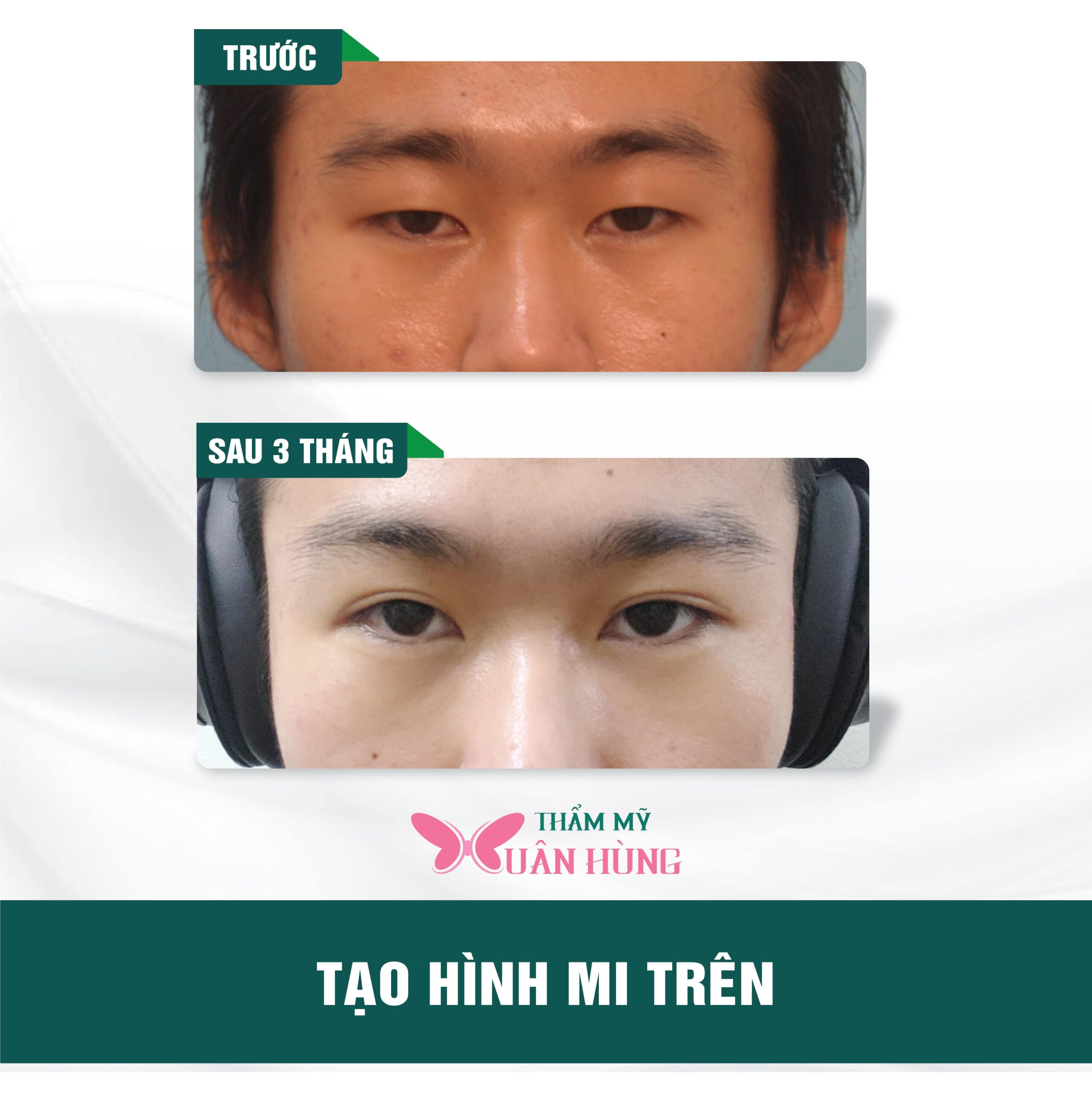 thẩm mỹ mắt ở đâu đẹp