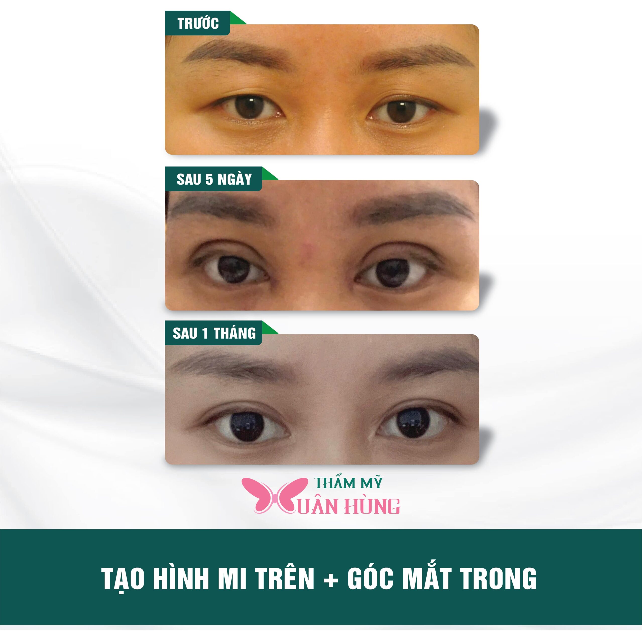 thẩm mỹ mắt ở đâu đẹp