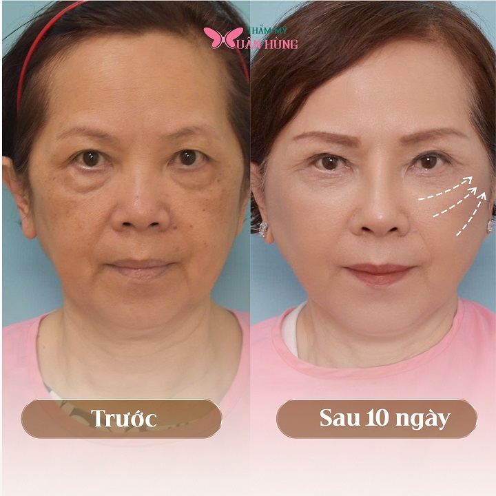 Khách hàng căng da mặt sau 10 ngày