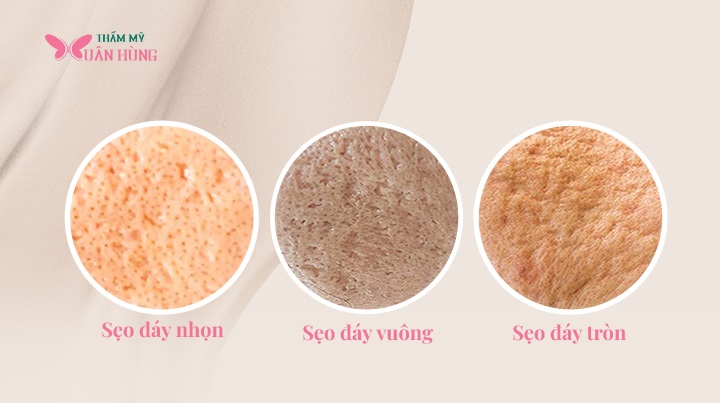 các loại sẹo rỗ