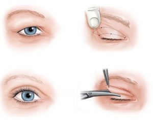Phẫu thuật thẩm mỹ mắt