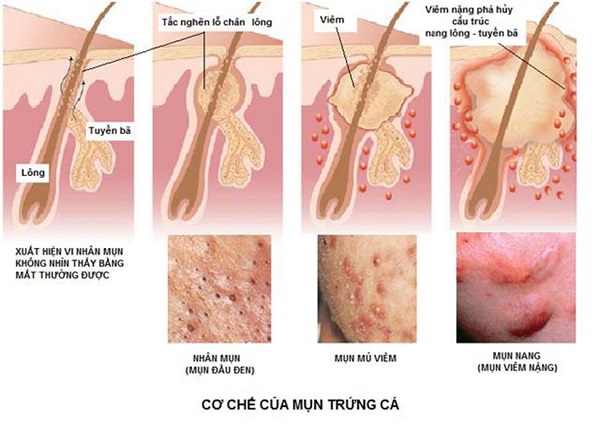 Điều trị mụn