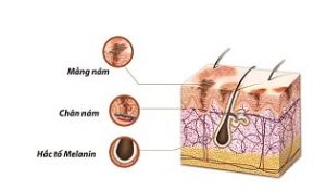 nguyên nhân gây nám da mặt