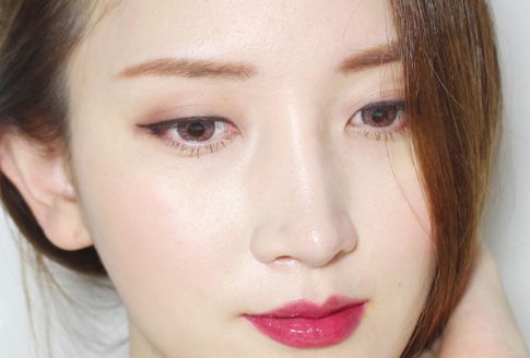 phẫu thuật thẩm mỹ mắt sụp mí