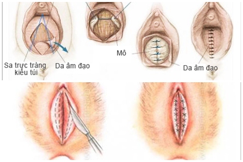 kinh nghiệm thẩm mỹ vùng kín