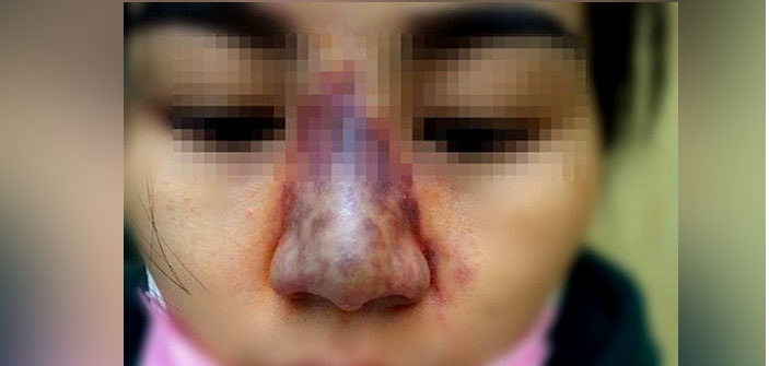 Dấu hiệu nhiễm trùng sau khi nâng mũi