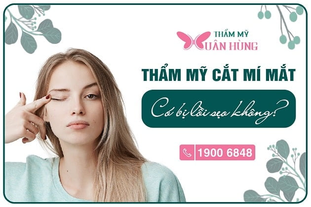 cắt mí mắt có bị sẹo lồi không