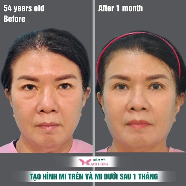 QUÁ TRÌNH CẮT MÍ KHÔNG ĐAU NHỜ ĐƯỢC GÂY TÊ CỤC BỘ AN TOÀN