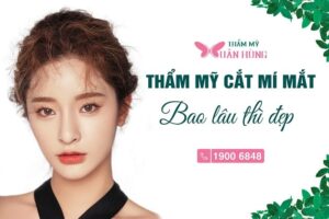 cắt mí mắt bao lâu thì đẹp