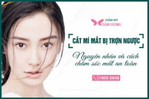 Cắt mí mắt bị trợn