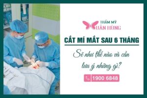 cắt mí sau 6 tháng