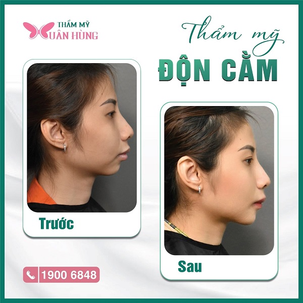 độn cằm có nguy hiểm không